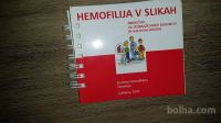 HEMOFILIJA V SLIKAH